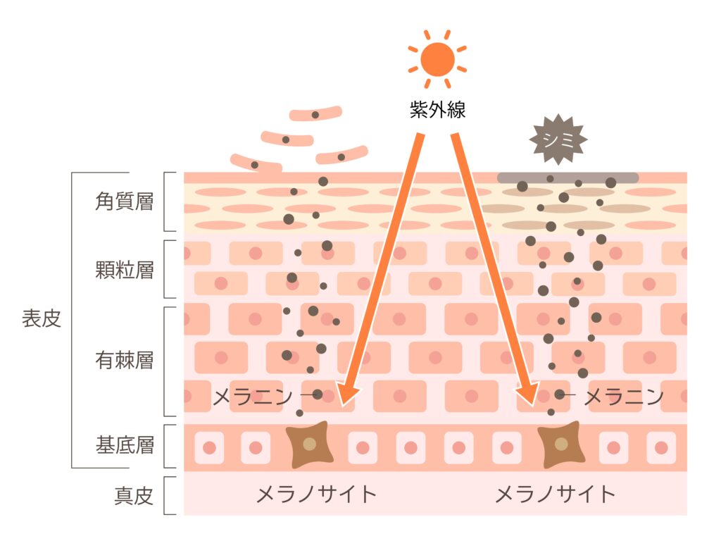 【保存版】シミの種類と原因、完全マップ - あなたのシミは何タイプ? シミが出来るまでの肌の断面図